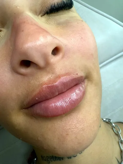 Resultado de harmonização labial: lábios com volume natural